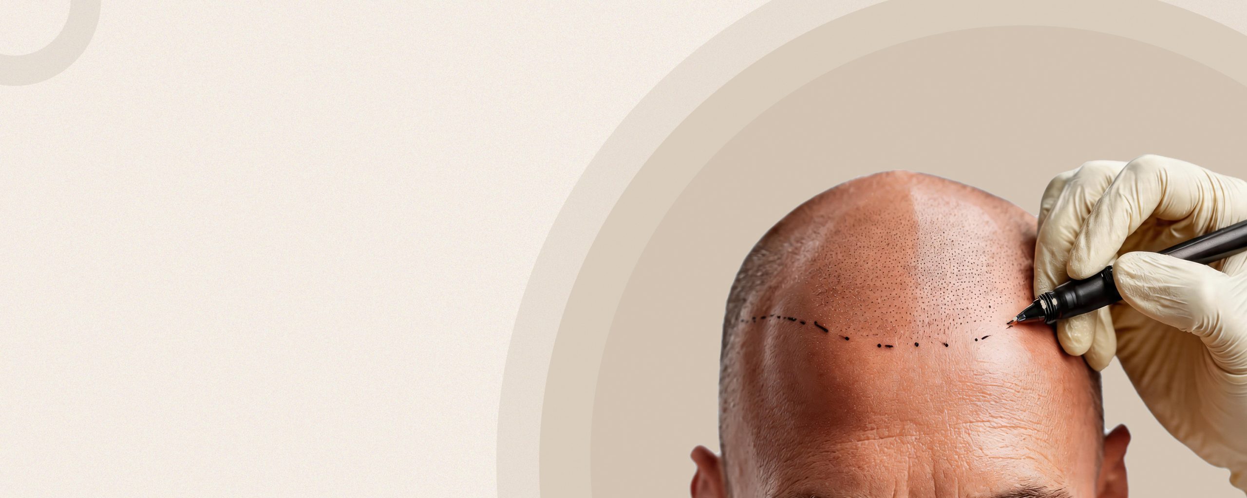 personalized hair restoration that looks natural